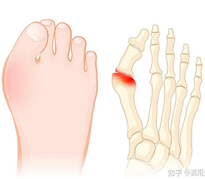 Hallux Valgus: Popoln znanstveni vodnik