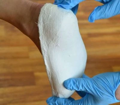 Kako bodo 3D skenerji stopal spremenili prihodnost ortopedskih podpornih naprav?