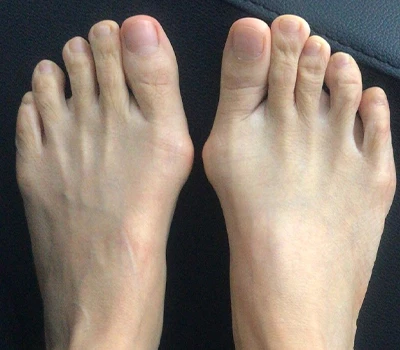Meritev Hallux Valgus: Zakaj 3D skenerji presegajo klinike in bolnišnice