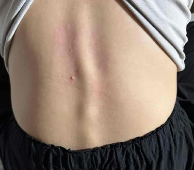 Celovita analiza skolioze: razumevanje stanja in tehnoloških inovacij pri ocenjevanju in upravljanju