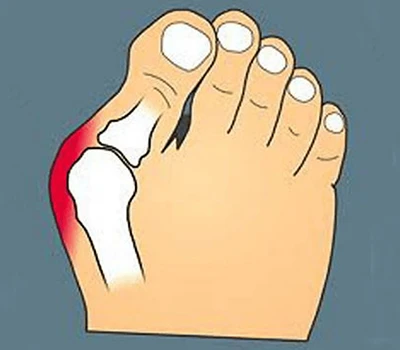 Transforming Bunion Care: Vključevanje natančnega skeniranja za izboljšano prilagajanje, sodelova...